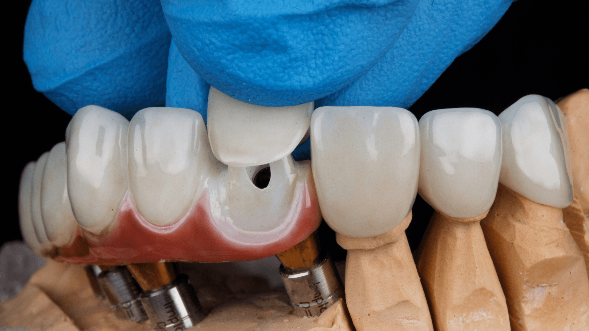 Professional dental crowns in Portland. Dr. Lee restores damaged teeth with custom crowns that look natural and last decades. Schedule today.