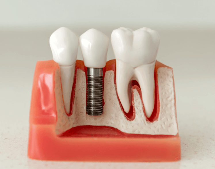 Dental Implants Portland | All-on-4 | Smile Transformations