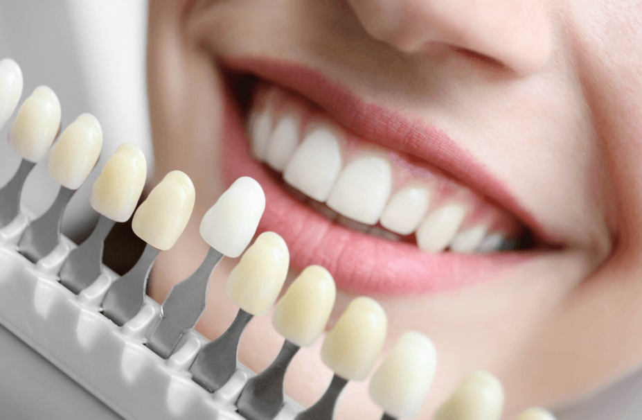 Years of Stains Gone! Professional Teeth Whitening Portland