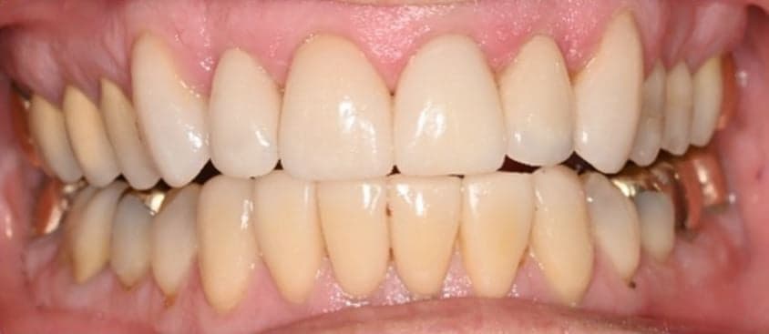 Patient smile transformation